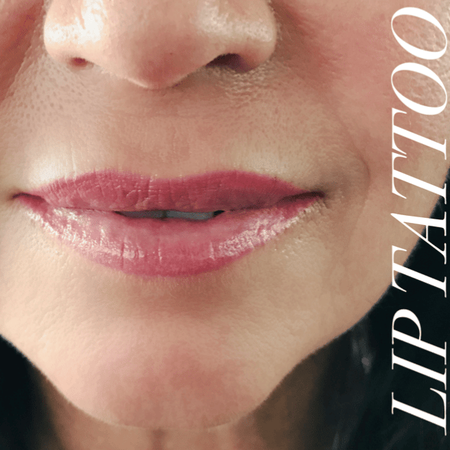 Fill lip
