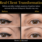 Laser eyeliner removal Auckland - before and after results at Brows and Beyond NZ